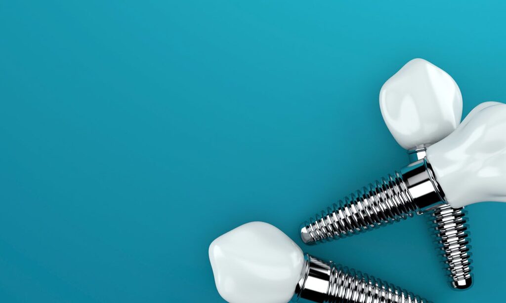 types of dental implants offered in Chicago Illinois